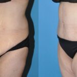Tummy Tuck #25 - Before and After