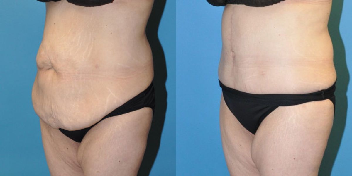 Tummy Tuck #25 - Before and After