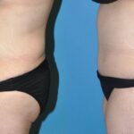 Tummy Tuck #25 - Before and After
