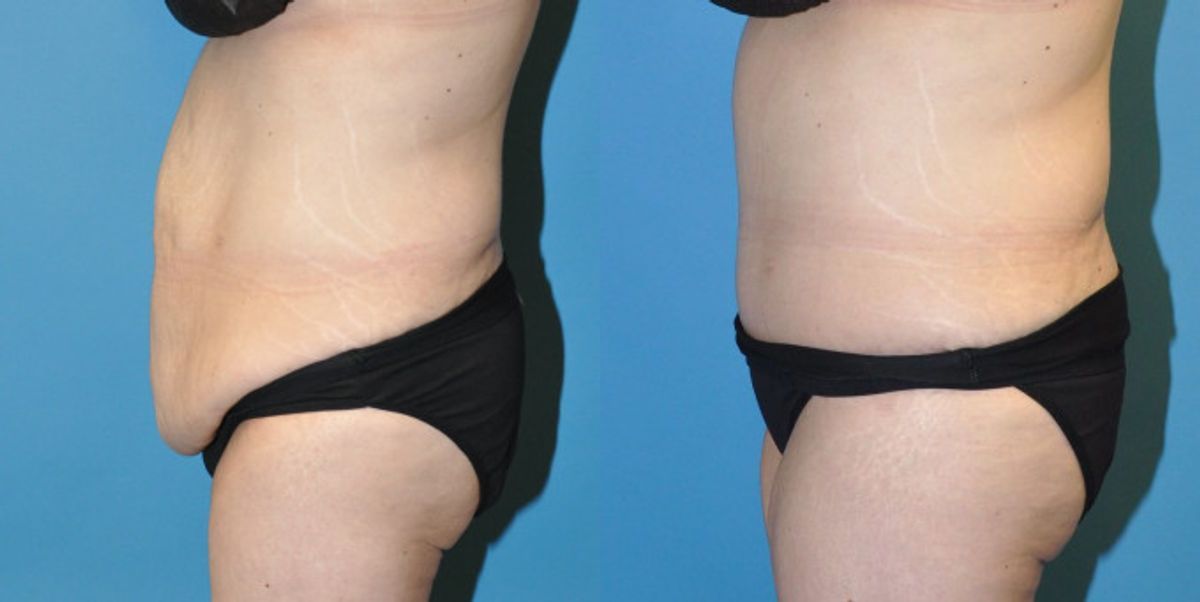 Tummy Tuck #25 - Before and After