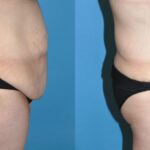 Tummy Tuck #25 - Before and After