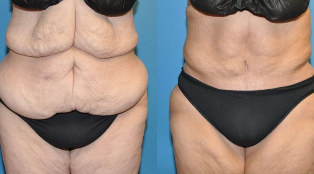 Tummy Tuck #26
