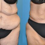 Tummy Tuck #26 - Before and After