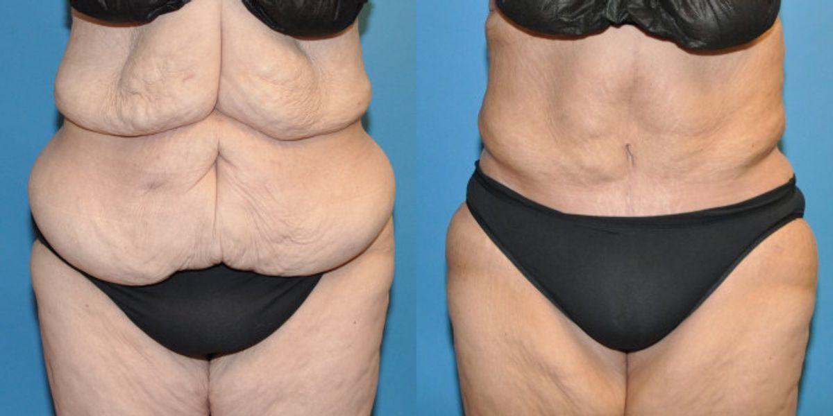 Tummy Tuck #26 - Before and After