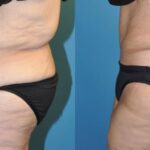 Tummy Tuck #26 - Before and After