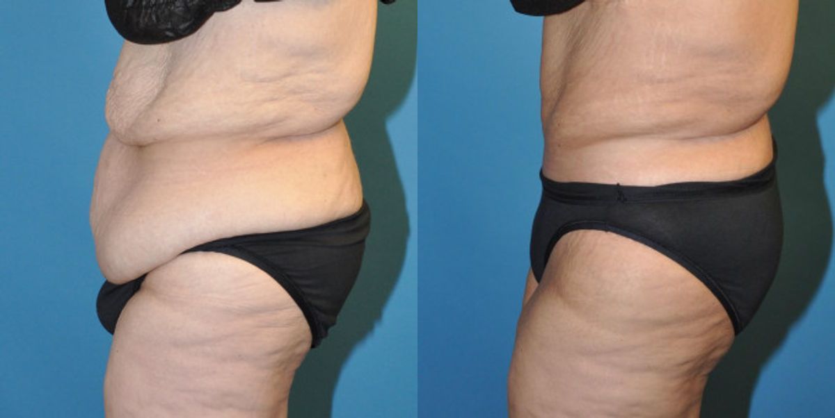 Tummy Tuck #26 - Before and After