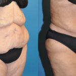 Tummy Tuck #26 - Before and After