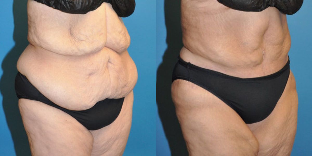 Tummy Tuck #26 - Before and After