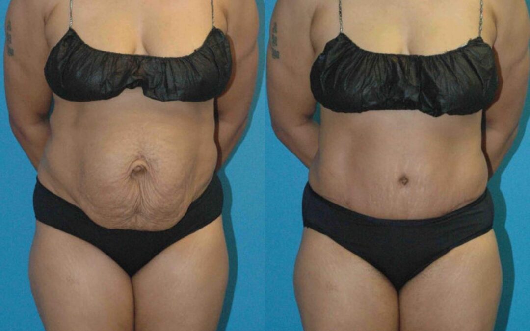 Tummy Tuck #27