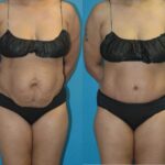 Tummy Tuck #27 - Before and After