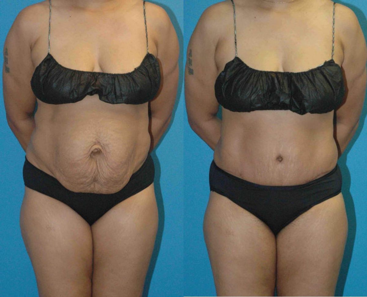 Tummy Tuck #27 - Before and After
