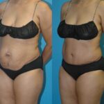 Tummy Tuck #27 - Before and After