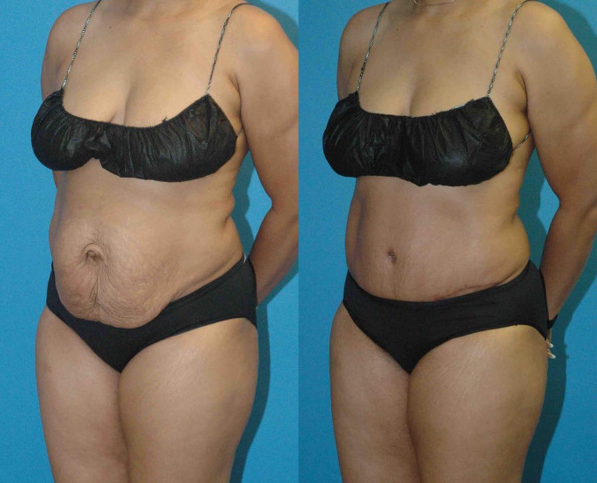 Tummy Tuck #27 - Before and After