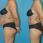Tummy Tuck #27 - Before and After
