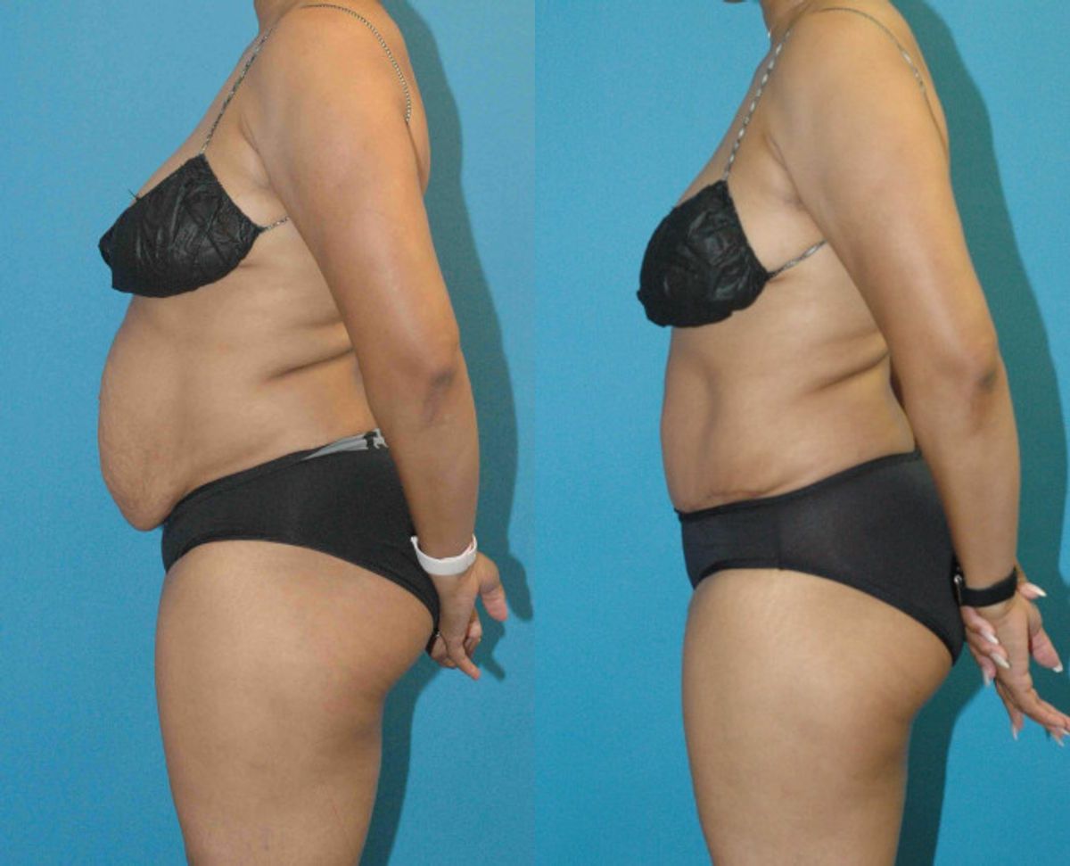Tummy Tuck #27 - Before and After