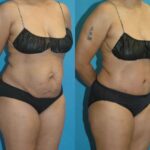 Tummy Tuck #27 - Before and After