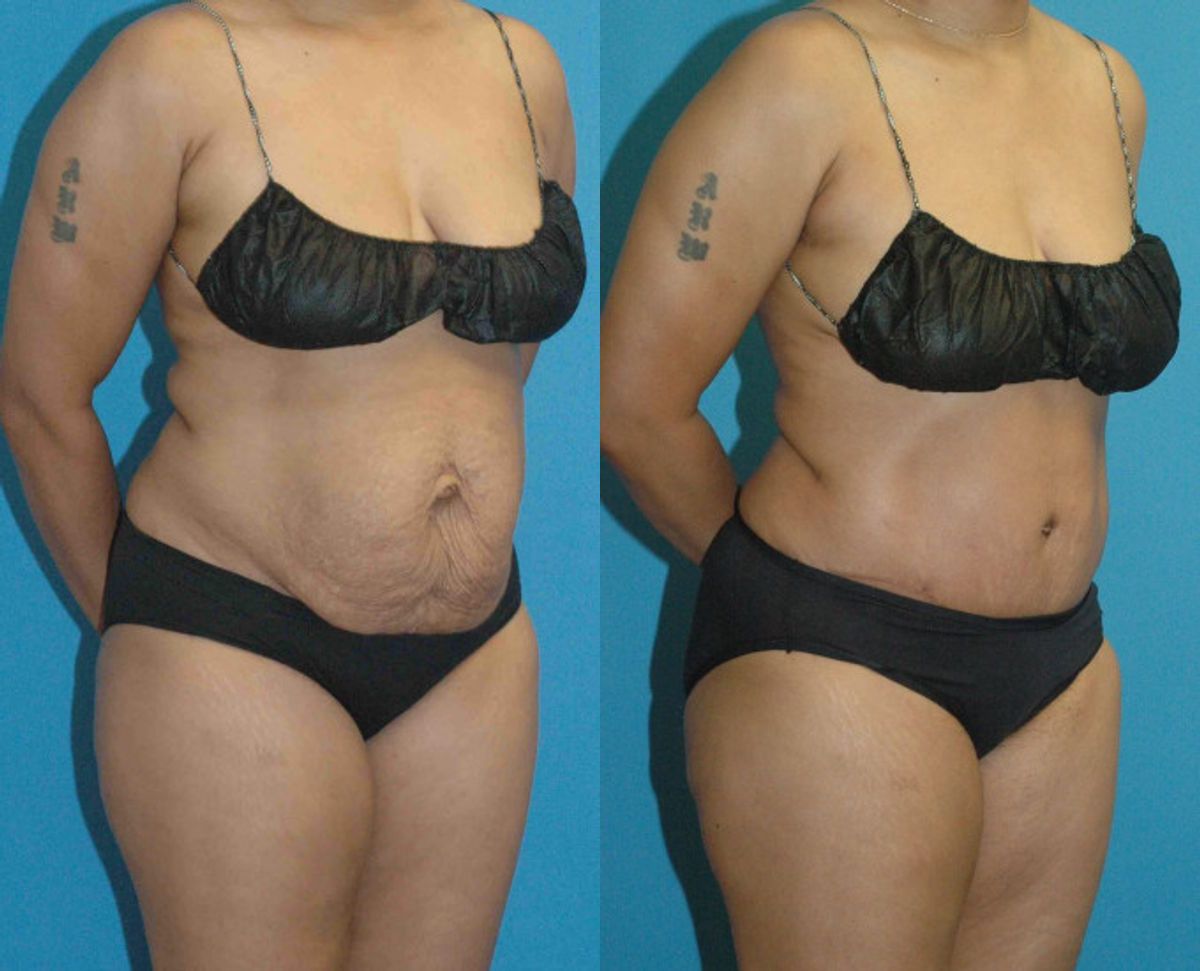 Tummy Tuck #27 - Before and After