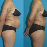 Tummy Tuck #27 - Before and After
