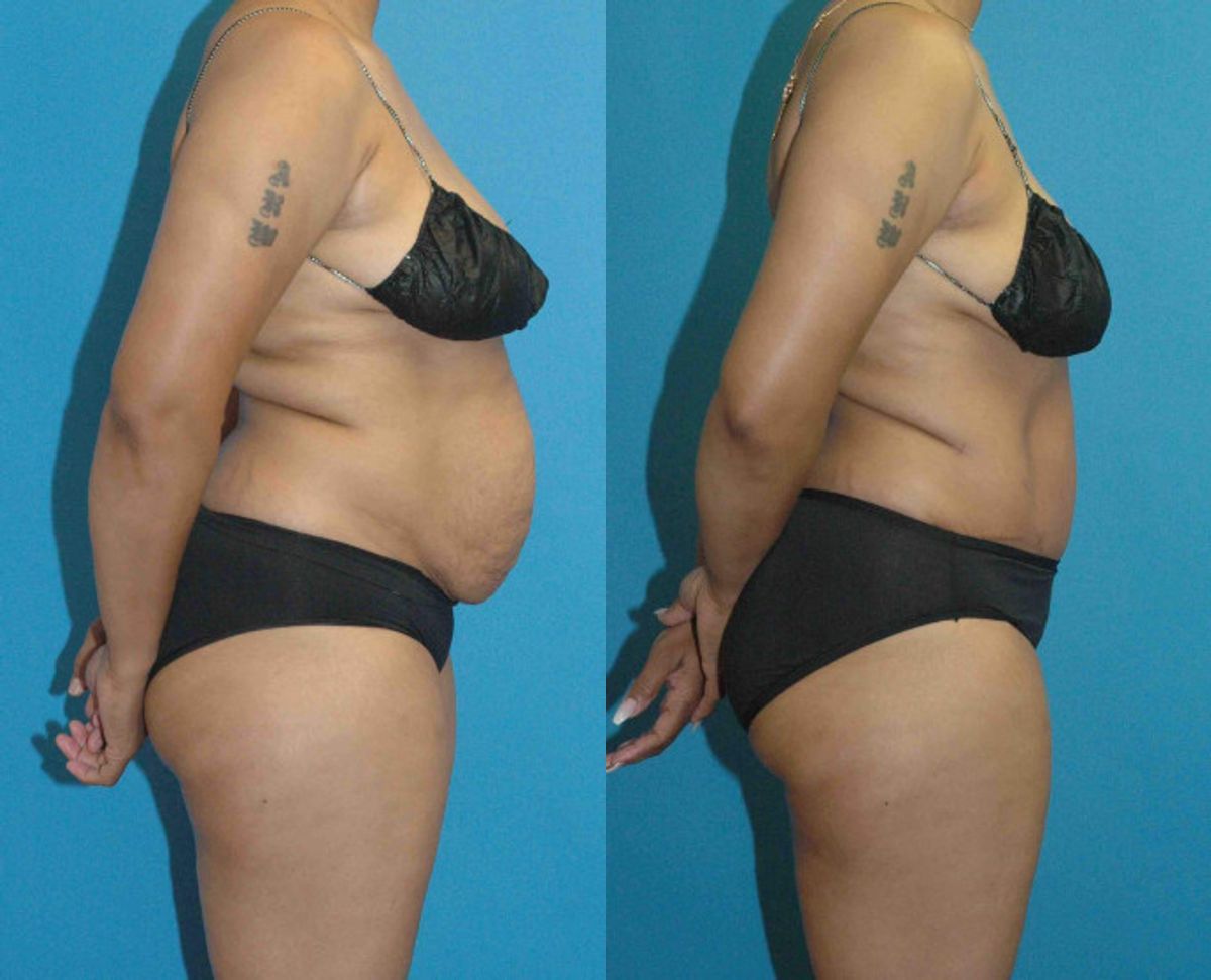 Tummy Tuck #27 - Before and After