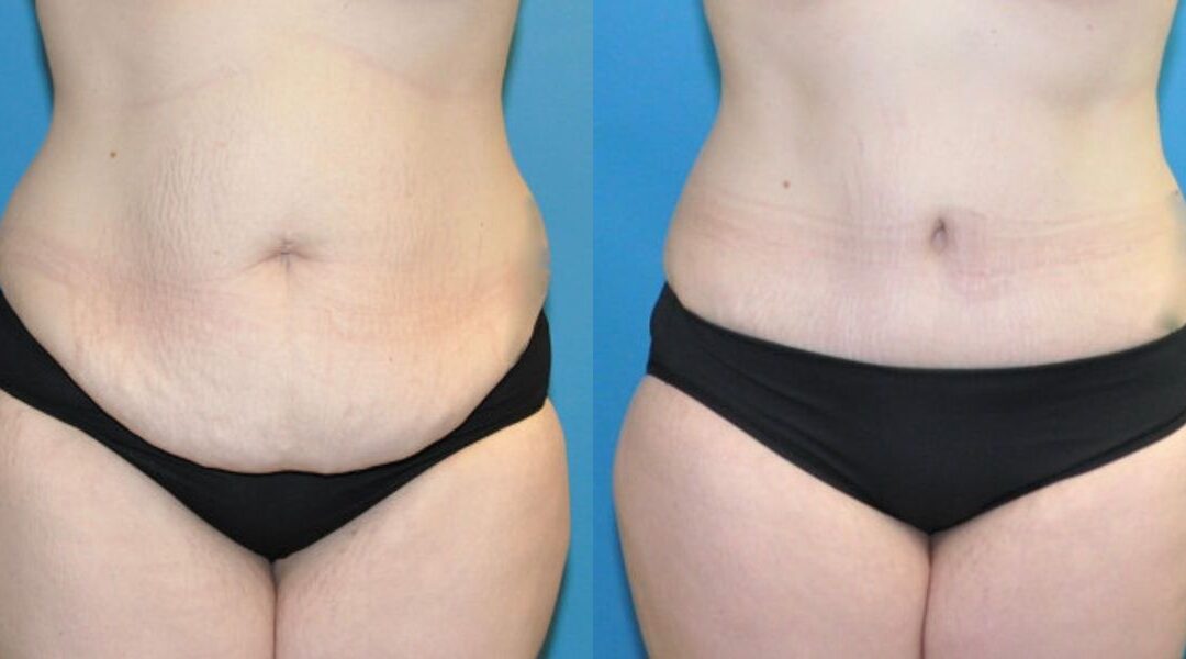 Tummy Tuck #28