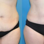 Tummy Tuck #28 - Before and After