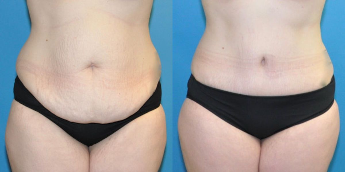 Tummy Tuck #28 - Before and After