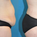 Tummy Tuck #28 - Before and After