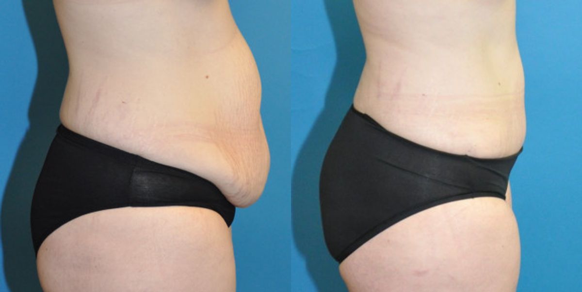 Tummy Tuck #28 - Before and After