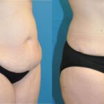 Tummy Tuck #28 - Before and After