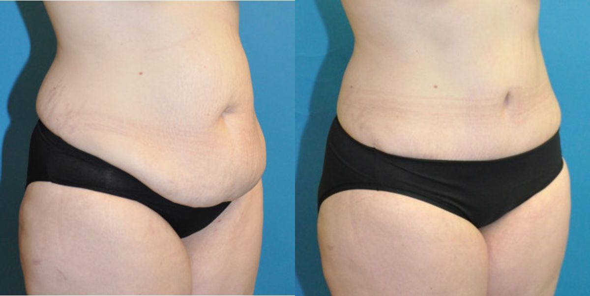 Tummy Tuck #28 - Before and After