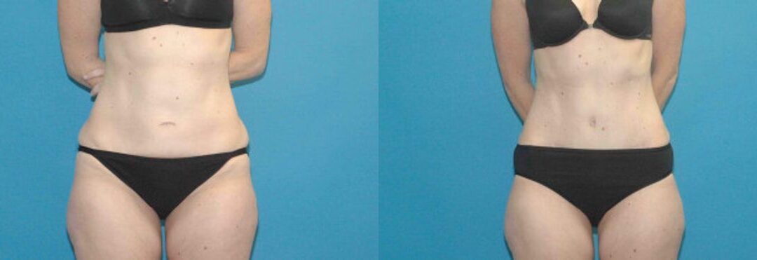 Tummy Tuck #29