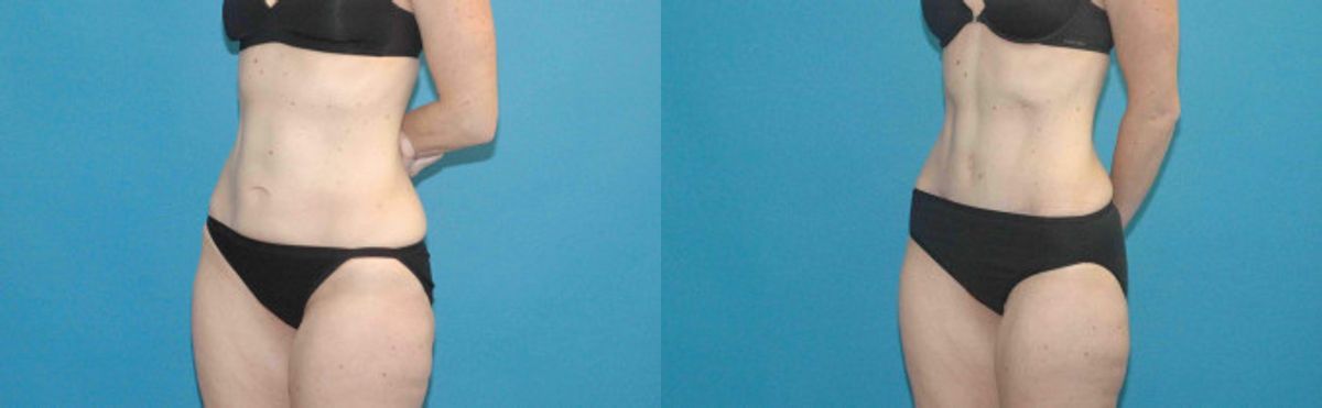 Tummy Tuck #29 - Before and After