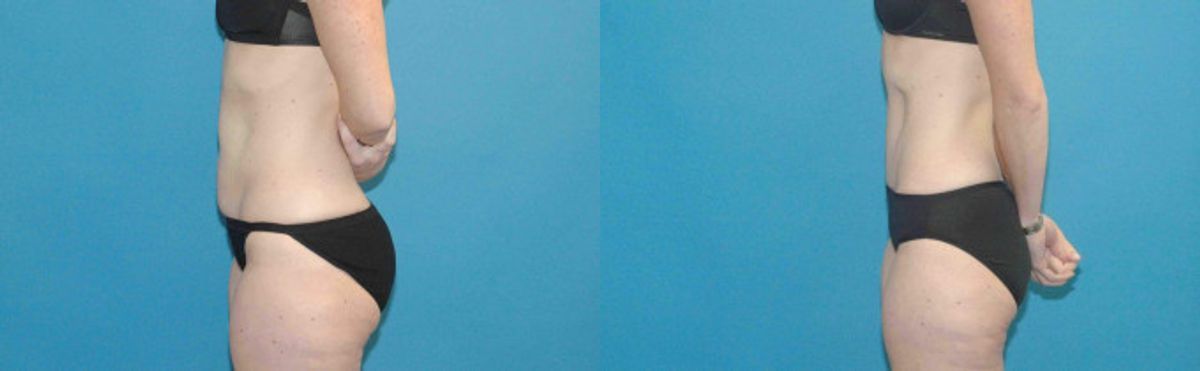 Tummy Tuck #29 - Before and After