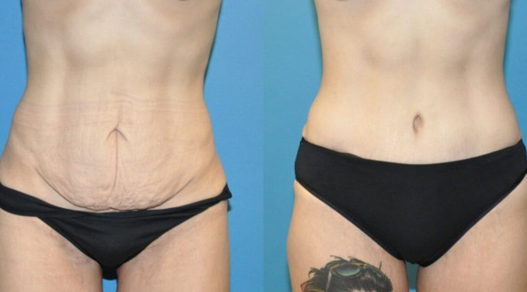 Tummy Tuck #30