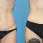 Tummy Tuck #30 - Before and After