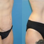Tummy Tuck #30 - Before and After