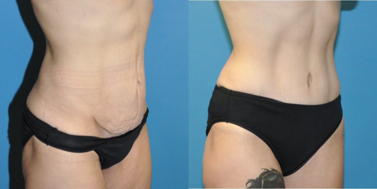 Tummy Tuck #30 - Before and After