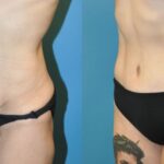 Tummy Tuck #30 - Before and After