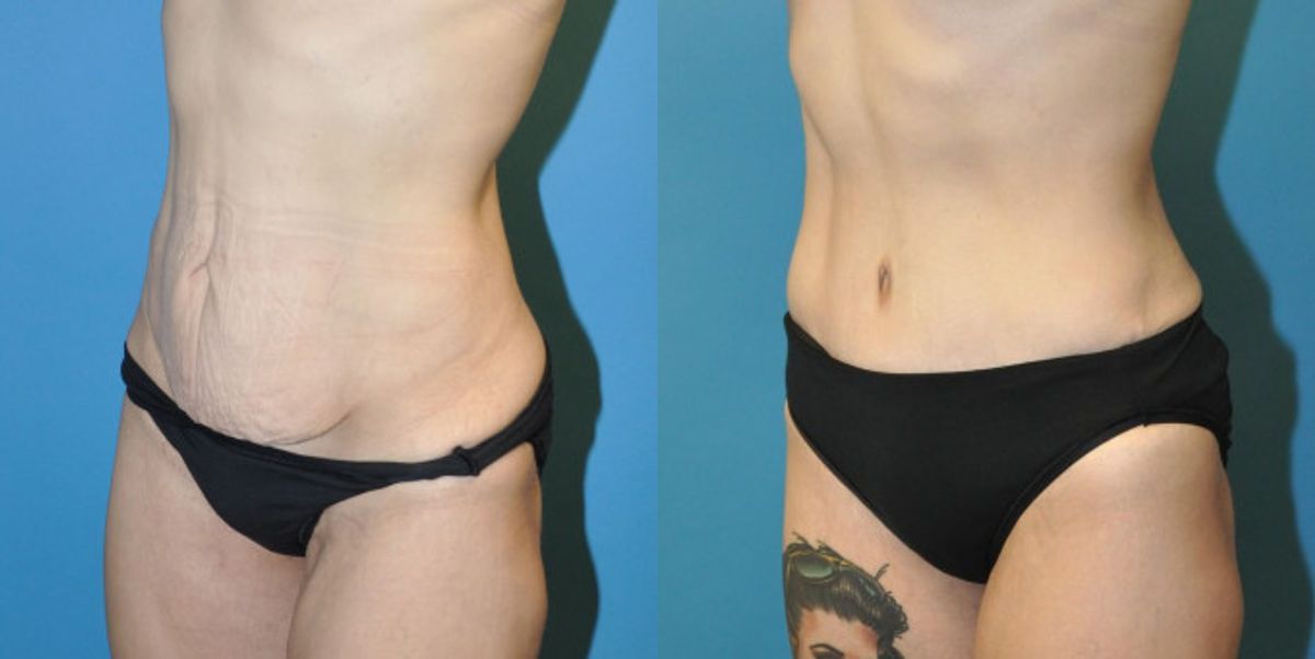 Tummy Tuck #30 - Before and After