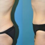Tummy Tuck #30 - Before and After