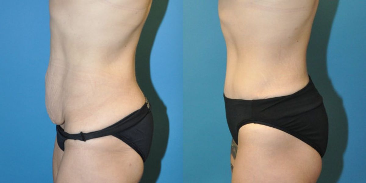Tummy Tuck #30 - Before and After