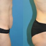 Tummy Tuck #30 - Before and After