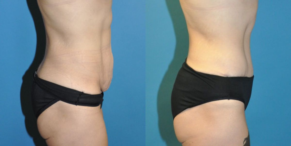 Tummy Tuck #30 - Before and After