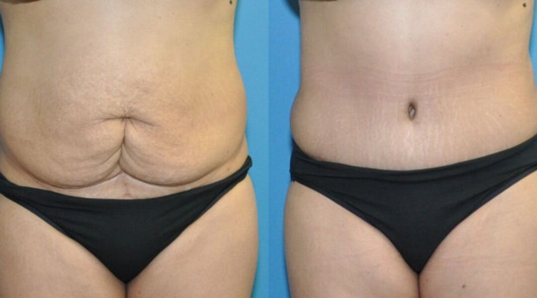 Tummy Tuck #31