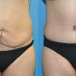 Tummy Tuck #31 - Before and After