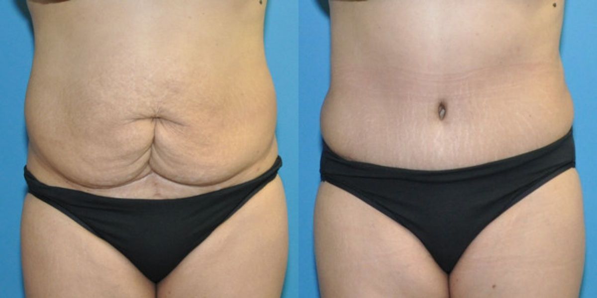 Tummy Tuck #31 - Before and After