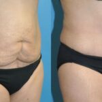 Tummy Tuck #31 - Before and After