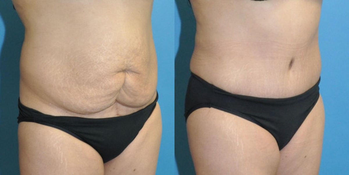 Tummy Tuck #31 - Before and After