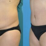Tummy Tuck #31 - Before and After