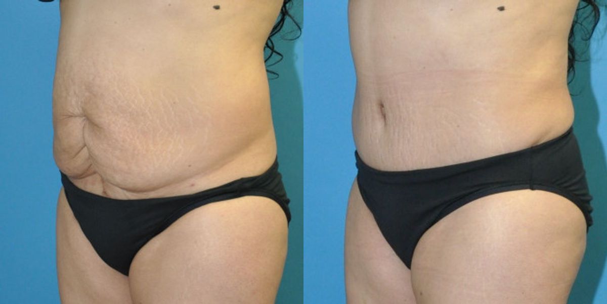 Tummy Tuck #31 - Before and After